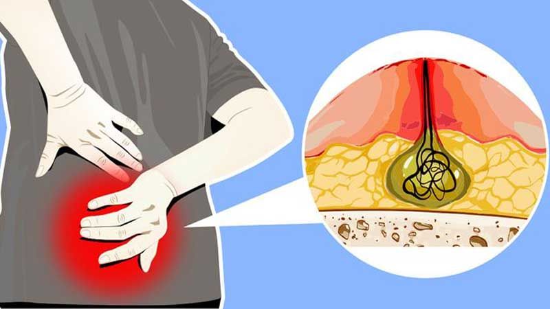سریع ترین راه درمان کیست مویی فقط با لیزر