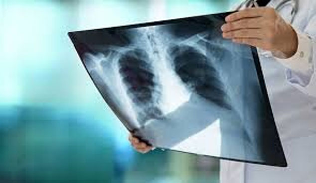 از کجا بفهمیم ریه‌هایمان درگیر "کرونا" شده است؟