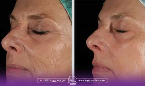 لیزر فوتونا چیست و چه مزایایی دارد؟