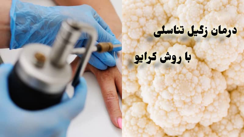 کرایو زگیل تناسلی چیست و چگونه انجام میشود؟