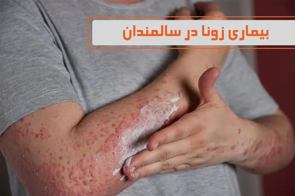 آیا بیماری زونا واگیردار است؟ | بیماری زونا در سالمندان