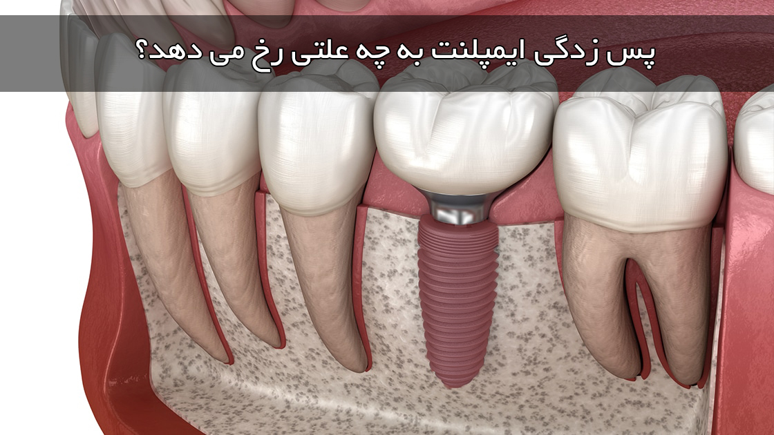 پس زدگی ایمپلنت به چه علتی رخ می دهد؟