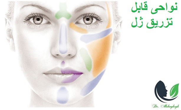 زوایه سازی صورت با تزریق فیلر