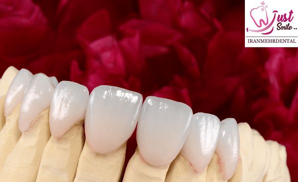 بهترین برندهای کامپوزیت دندان در سال 2022