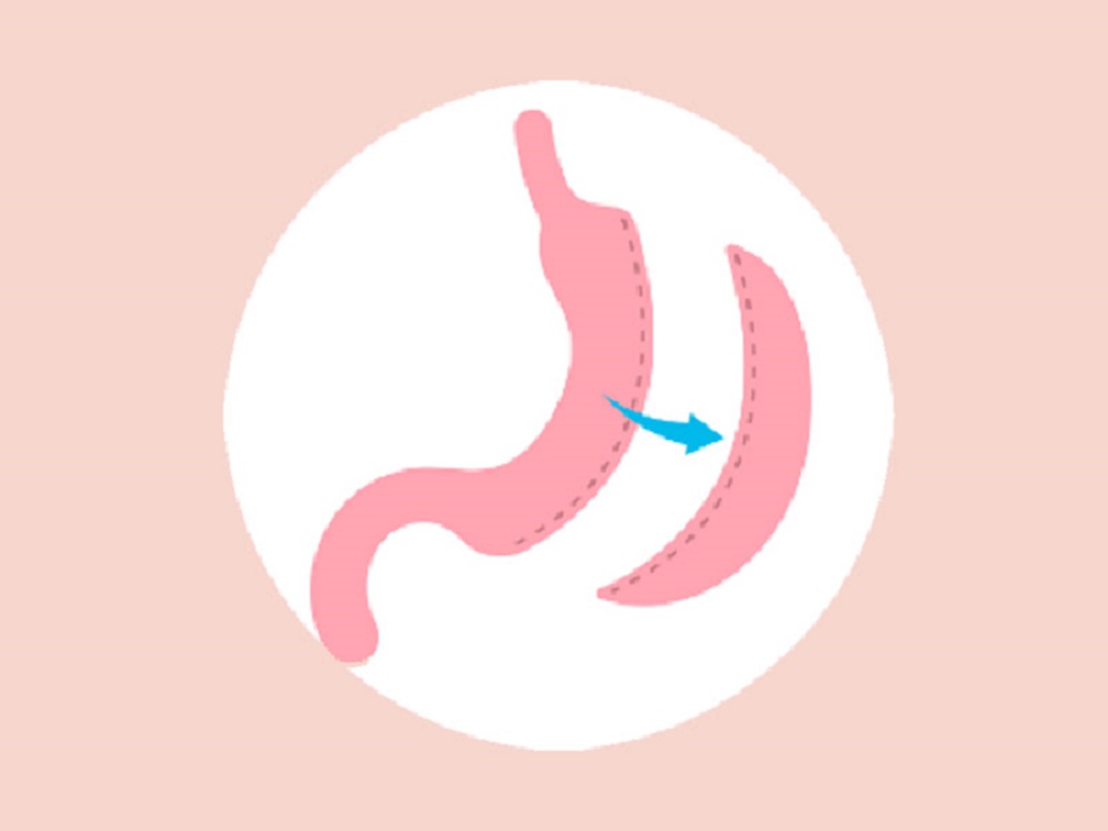 عمل اسلیو معده را همه نمی توانند انجام دهند!