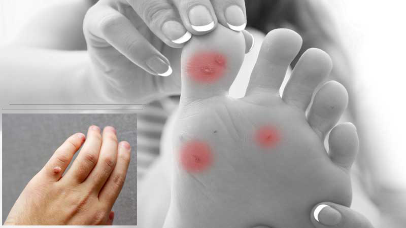 آیا زگیل دست و پا مسری است؟