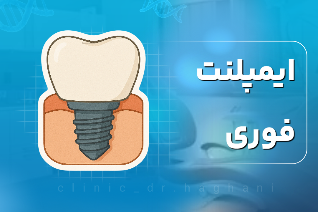 ایمپلنت فوری دندان در تهران