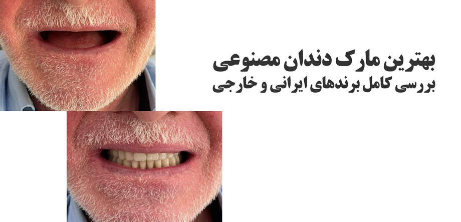 بهترین مارک دندان مصنوعی کدام است؟ بررسی کامل برندهای ایرانی و خارجی