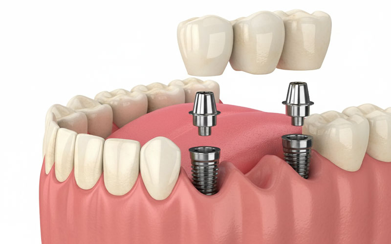 طول عمر ایمپلنت دندان چقدر است؟