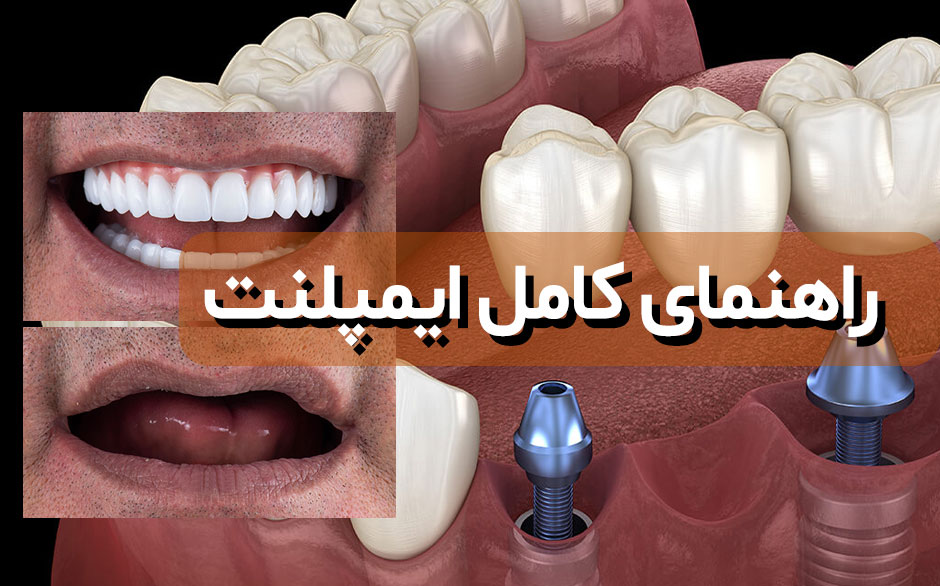 همه چیز درباره ایمپلنت دندان: راهنمای کامل برای داشتن دندان‌های ماندگار